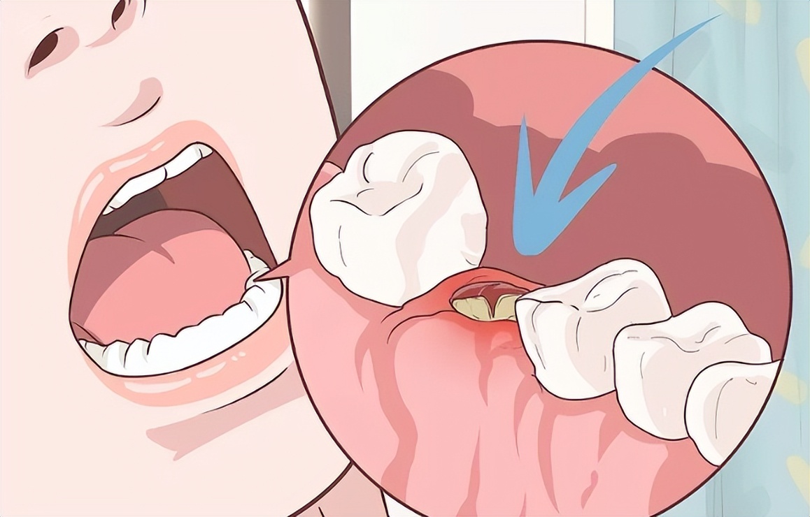 拔牙吃止疼药影响伤口愈合吗,拔牙后伤口愈合后感觉更疼