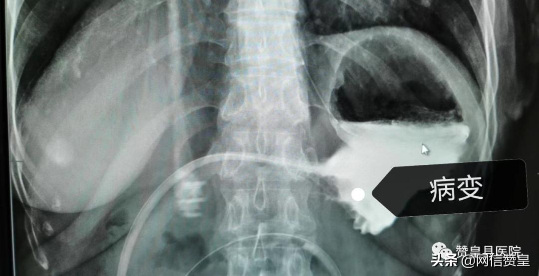 胃窦癌微创切除手术,胃窦癌根治切除术