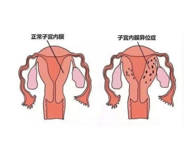 卵巢功能早衰与内分泌失调的区别,长期没有性生活会内分泌失调吗