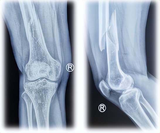 更好服务患者西安市红会医院骨不连专科门诊开诊