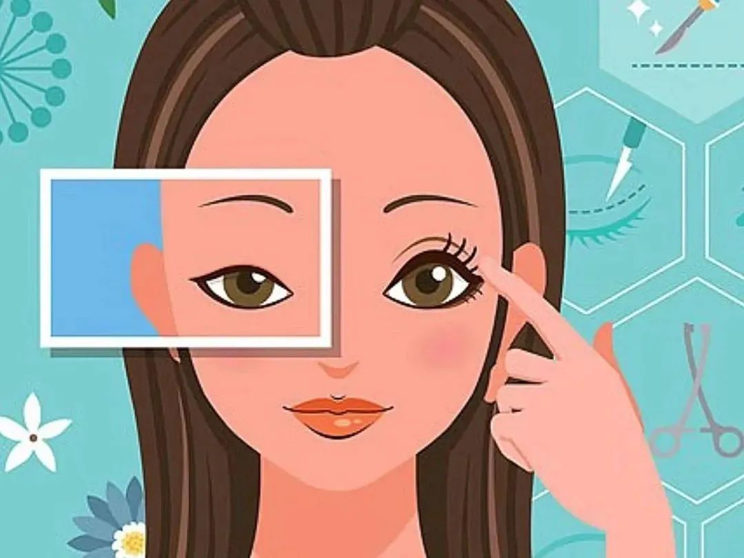 常见三种双眼皮手术的比较与分析,你应该选择哪种双眼皮手术方法