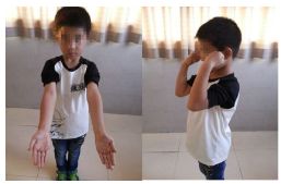 肱骨骨折取钢板怎样恢复,肱骨近端骨折切开复位内固定术