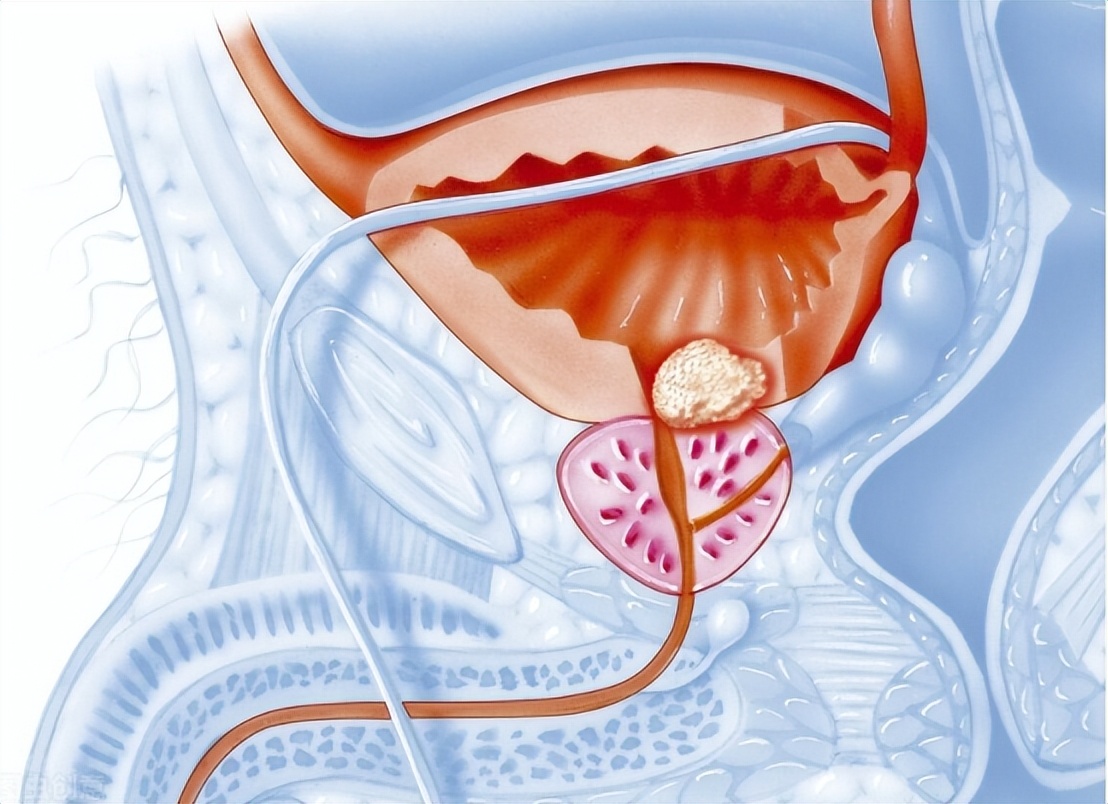 医院内尿路感染常见的诱因,尿路感染最严重的后果