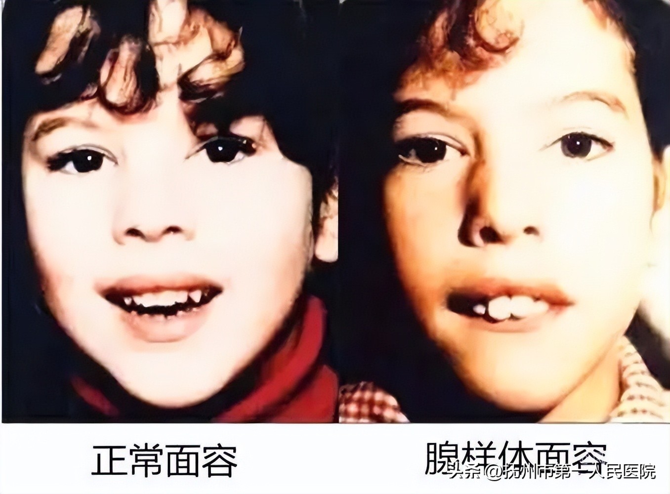 厦门耳鼻喉医院扁桃体切除,耳鼻喉科扁桃体切除术用什么方法