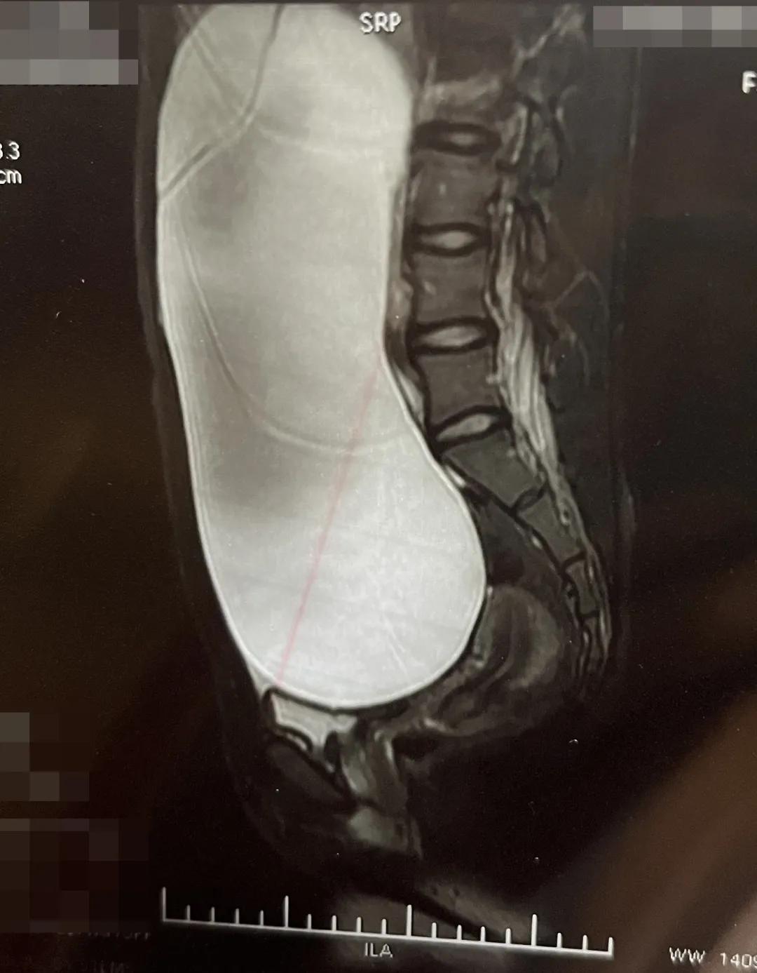 肚脐里长馒头状的肿物,肚脐上方摸到好多类似结节的疙瘩