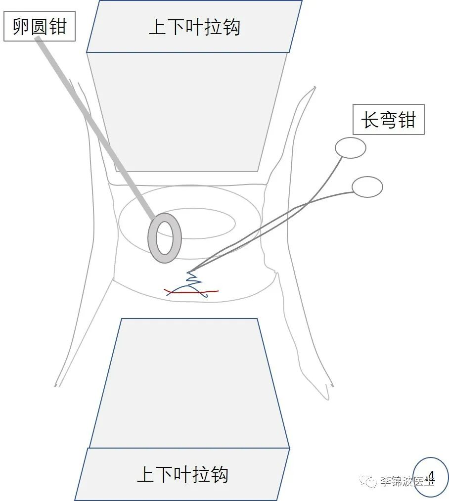 拆除高位宫颈环扎线的步骤和注意事项