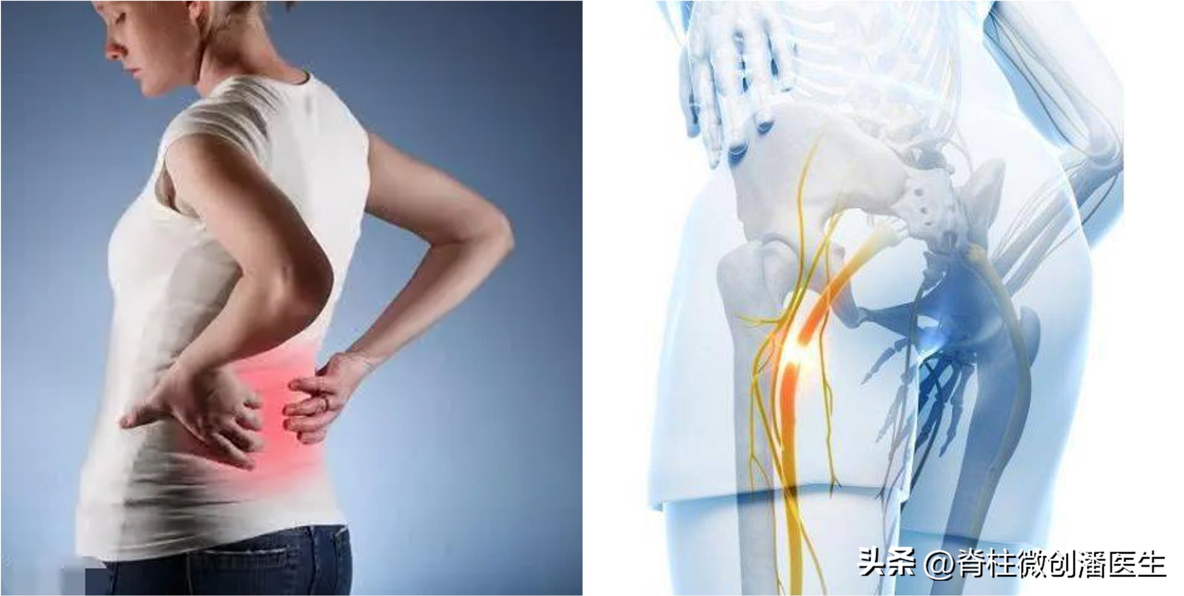 腰椎骶化会造成坐骨神经痛吗,骶椎腰化需要治疗吗