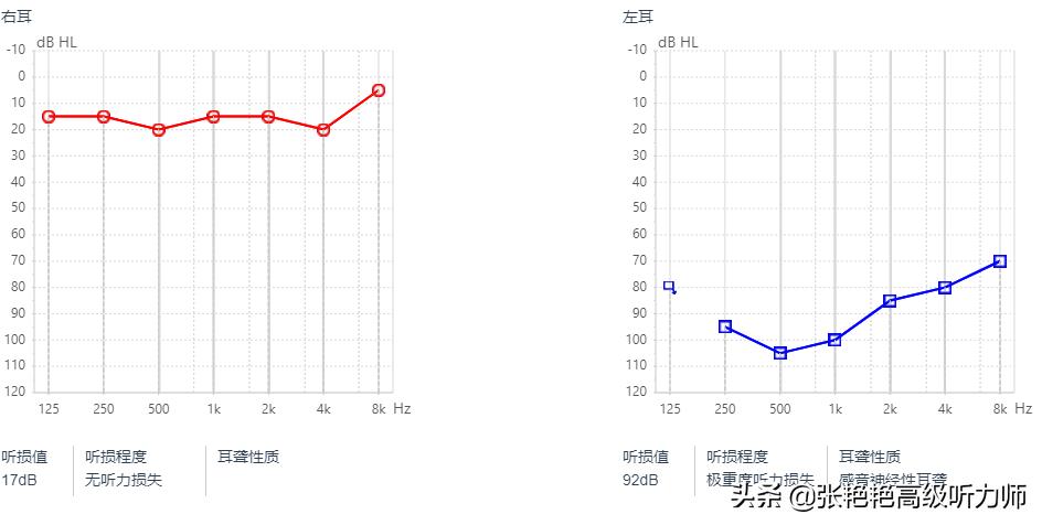 两只耳朵听力不一样正常么,2个耳朵听到的声音不同步