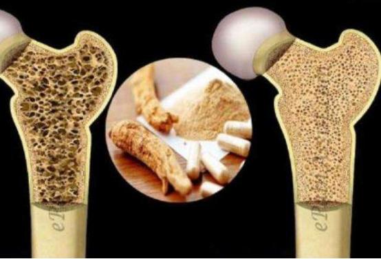 骨密度下降严重怎样系统治疗,骨密度下降用什么药好
