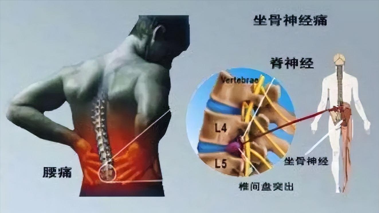 甲钴胺治疗腰椎间盘突出吃几片 (甲钴胺片治疗腰椎间盘突出吃多久)