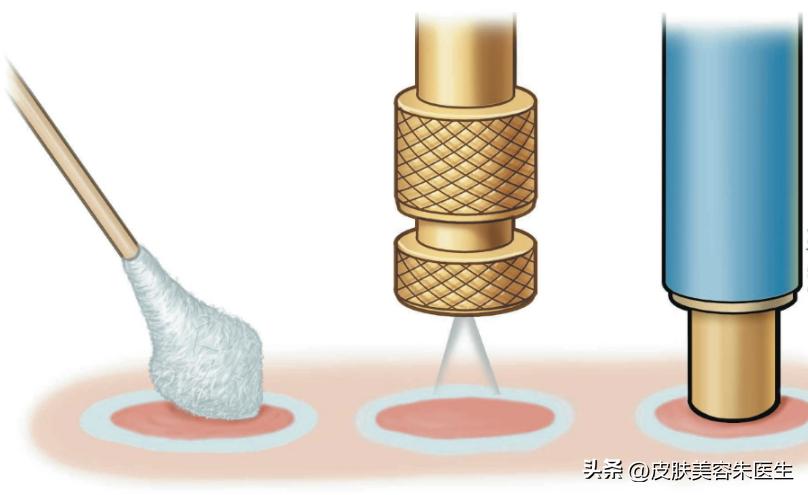 一周治愈尖锐性湿疣科学方法,刚发现尖锐性湿疣可以完全治愈吗