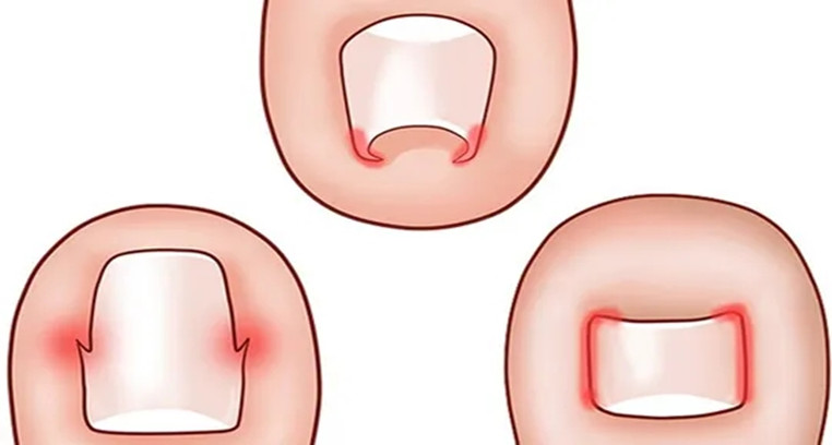 脚趾甲老往肉里钻，一碰还疼？教你小妙招，预防甲沟炎告别疼痛
