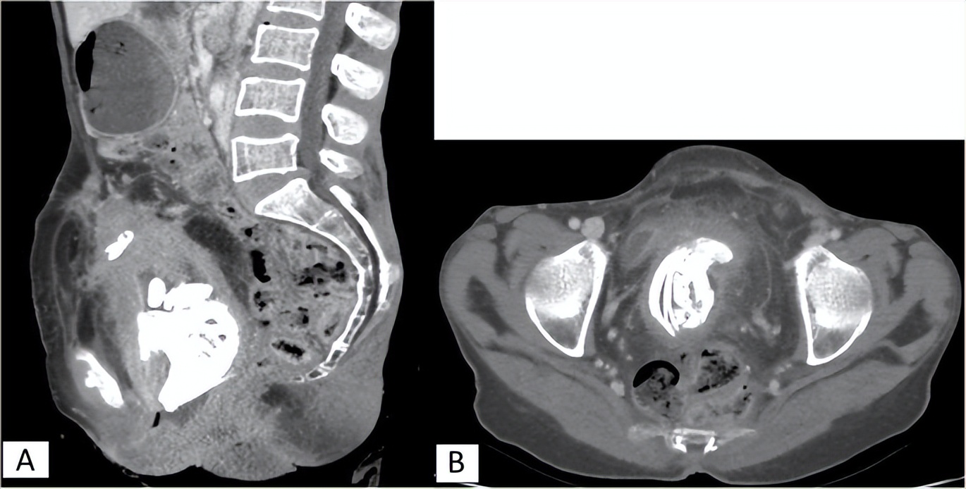 胎死腹中后孕妇有危险吗,最严重胎死腹中