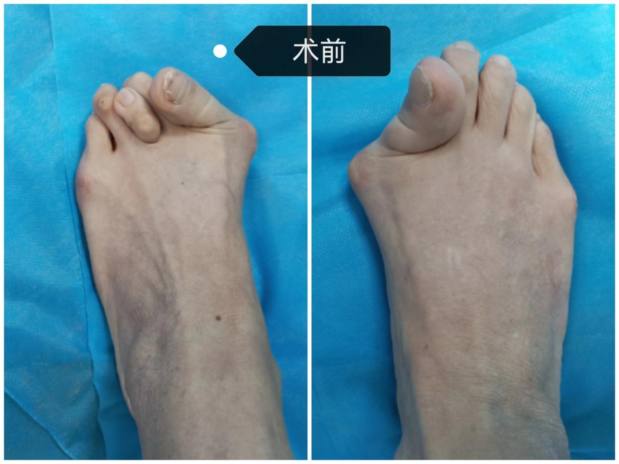 脚趾外翻疼痛怎么治,脚趾外翻肿痛怎么消肿