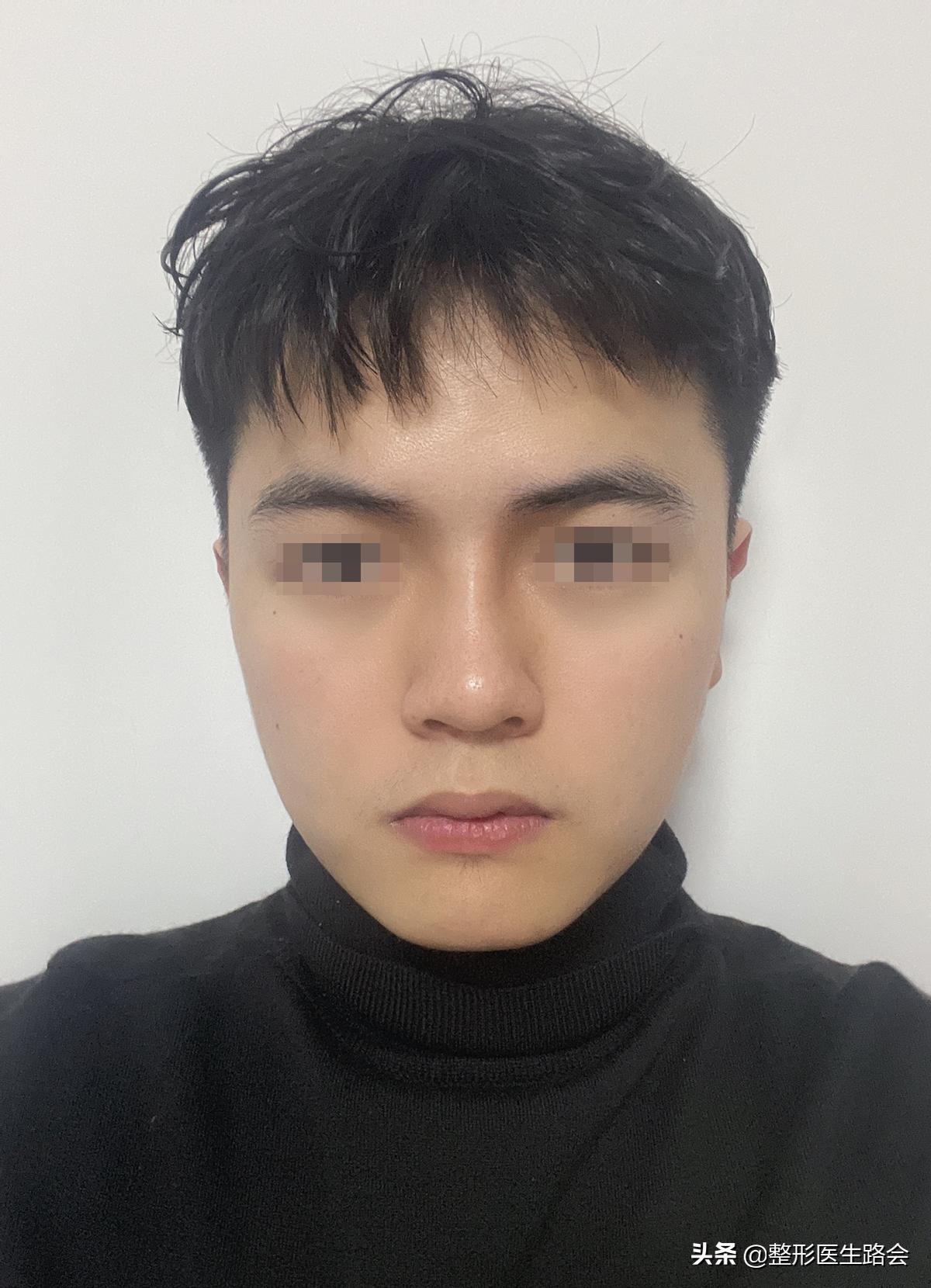 24岁小伙子隆鼻,隆鼻手术效果图解对比照