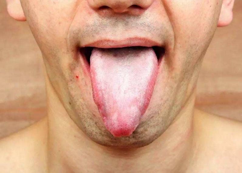 一整天口干口苦舌燥大病预兆,一整天口苦要警惕三种病