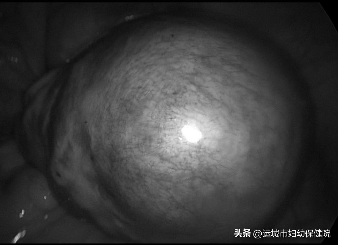 科普｜带你认识困扰女性的子宫腺肌症