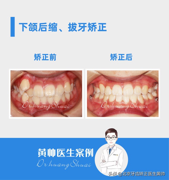 嘴凸的人怎么笑起来好看,嘴型比较凸的人怎么改善