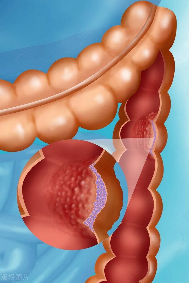 不容忽视的息肉很容易变成癌,肠息肉不可小觑