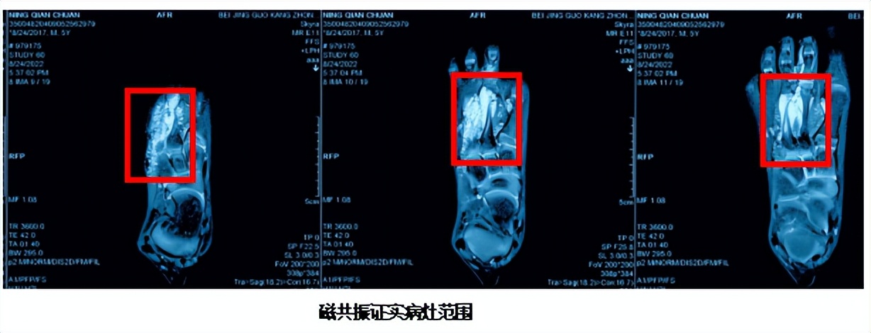 疣状静脉畸形介入治疗,下肢静脉畸形介入手术全过程
