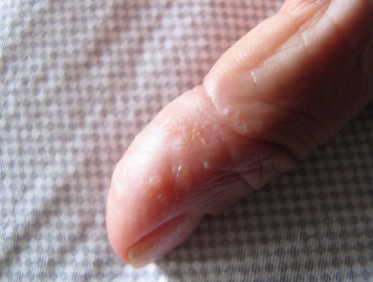 手上起小水泡很痒应该抹什么药膏,手上起小水泡又痒又疼怎么办