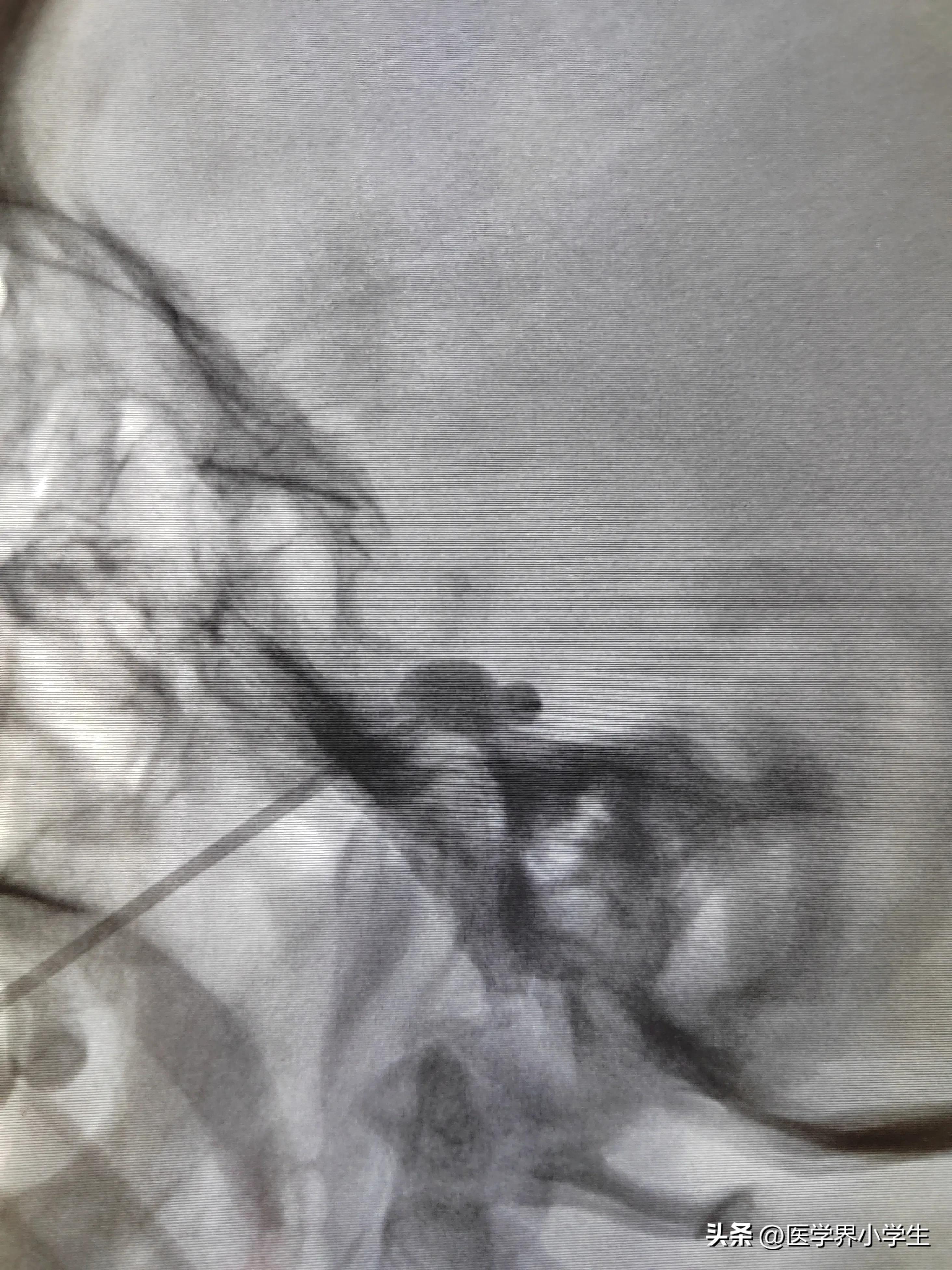 民间小偏方治三叉神经,三叉神经痛四个疗程能彻底治愈吗