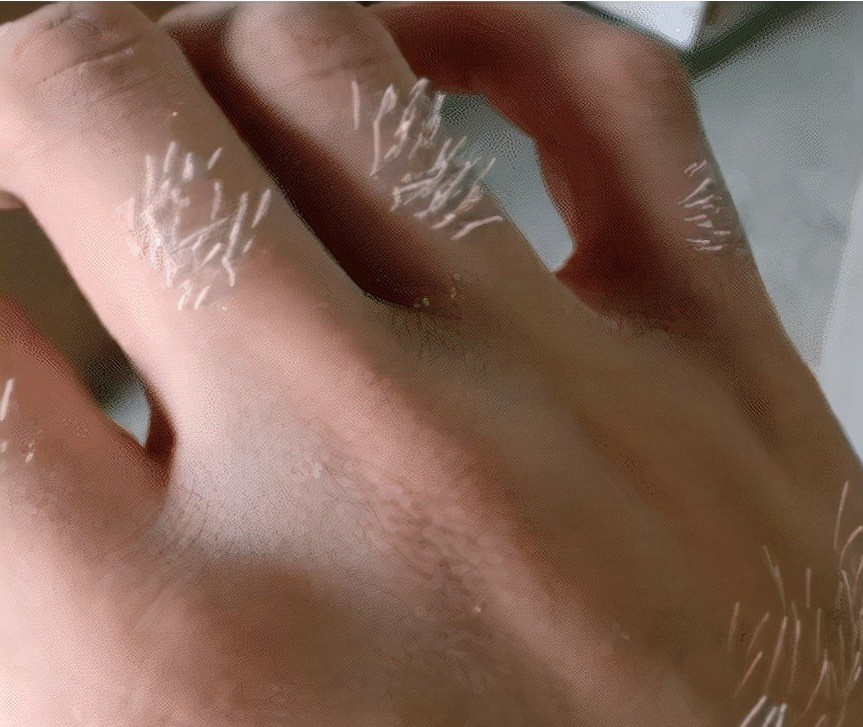 手上长了一条白毛可以拔掉吗,手上长了一条白毛是什么原因