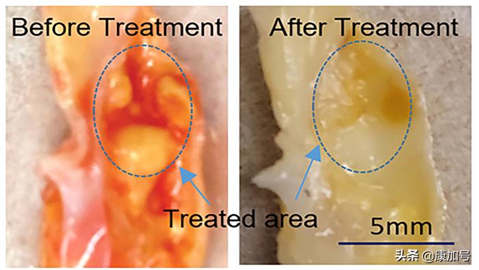 动脉斑块激光消融术,冠状动脉粥样硬化的激光治疗