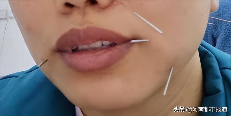 当孕期遇上荨麻疹,孕期面瘫