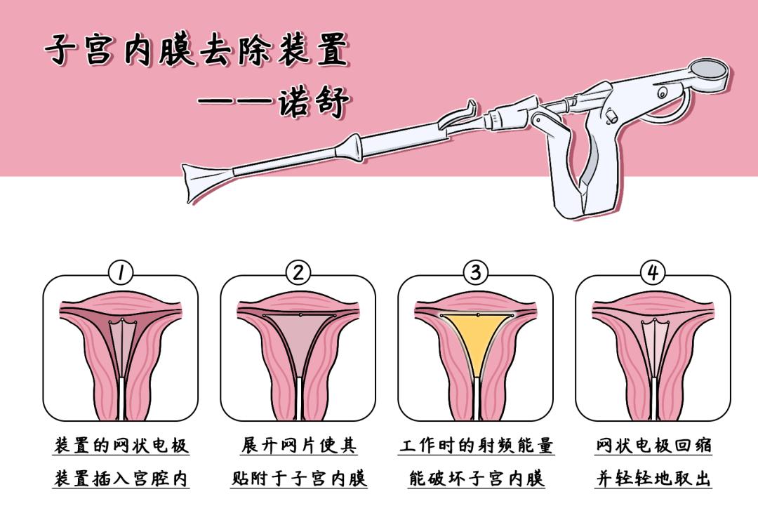 短短90秒就能再也不来月经，还有这种好事？