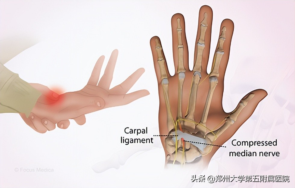 5个妙招帮你远离鼠标手,一招教你解决鼠标手