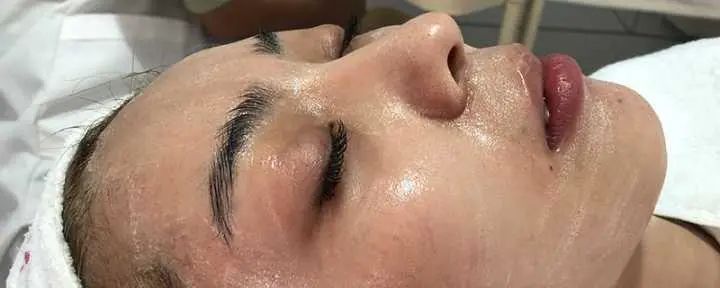 维a酸乳膏可以改善毛孔粗大吗,油皮毛孔粗大黑头多要怎么改善