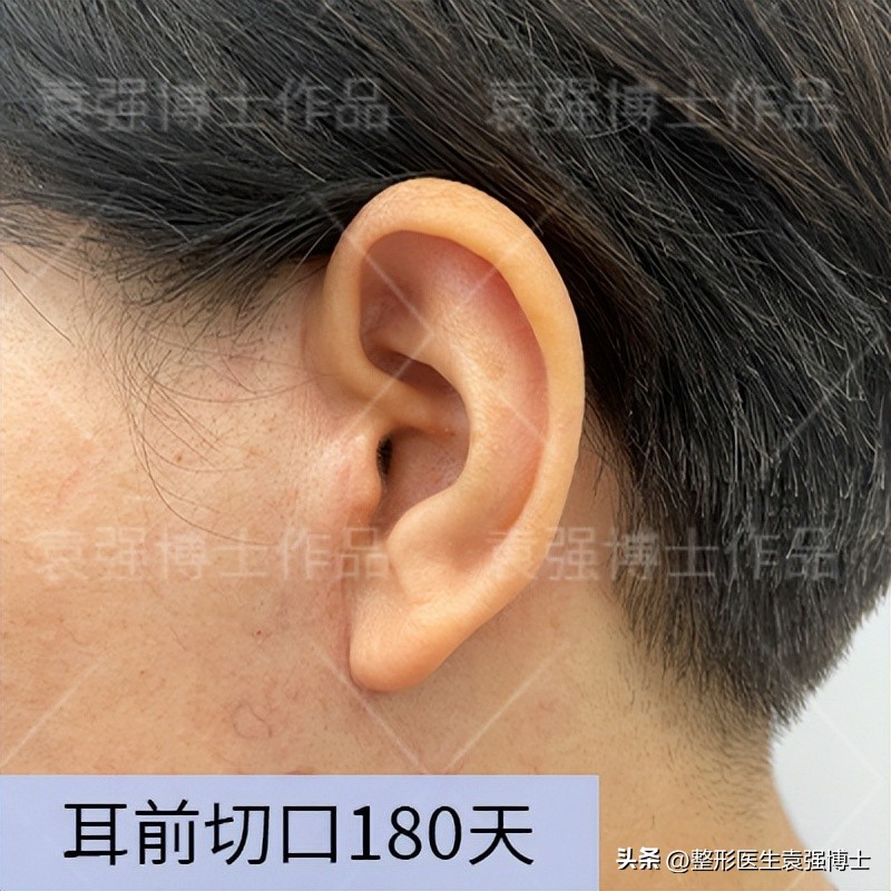 做拉皮手术前一定要明白这几点,医生不建议做拉皮手术