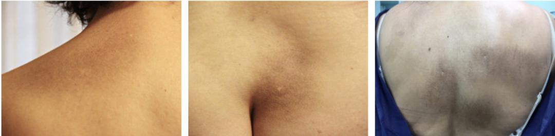 腿部长斑像烫伤一样,年轻人腿部长斑