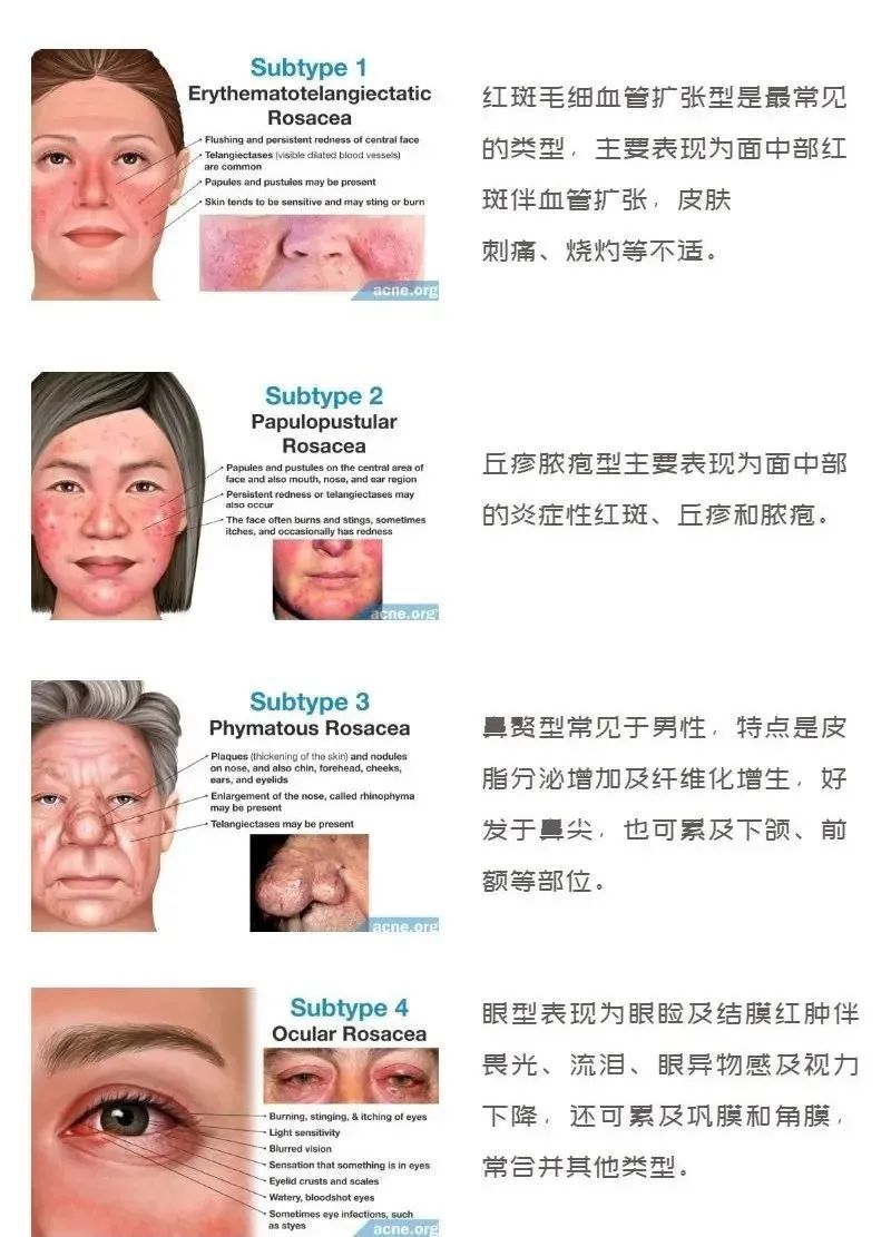 让人崩溃的酒渣鼻，这些日常护理重点你知道吗？