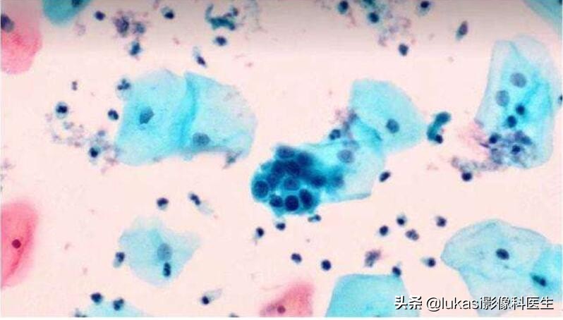 宫颈癌的可怕之处,宫颈癌日益年轻化加强筛查是重点