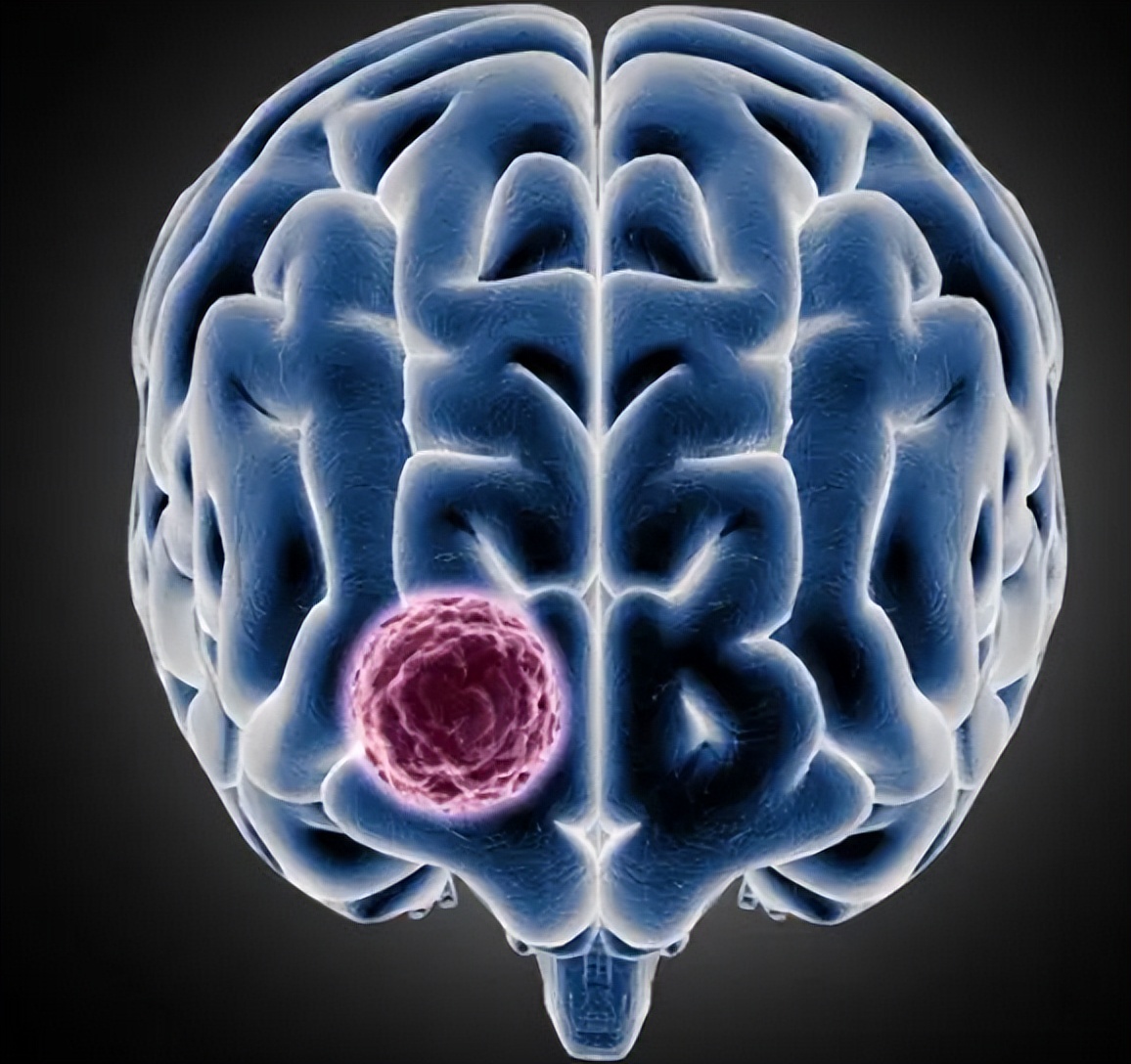 脑瘤能治好吗最明显的4个征兆,脑瘤要怎么治疗比较好