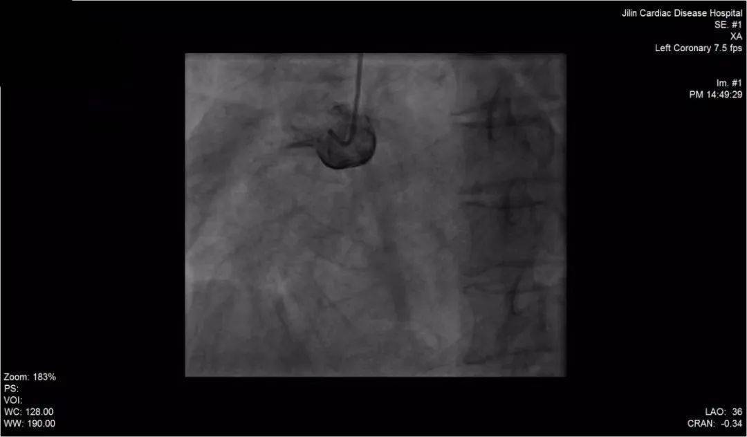 吉心风采｜黄金时间仅剩2小时，心内团队跑赢生死时速