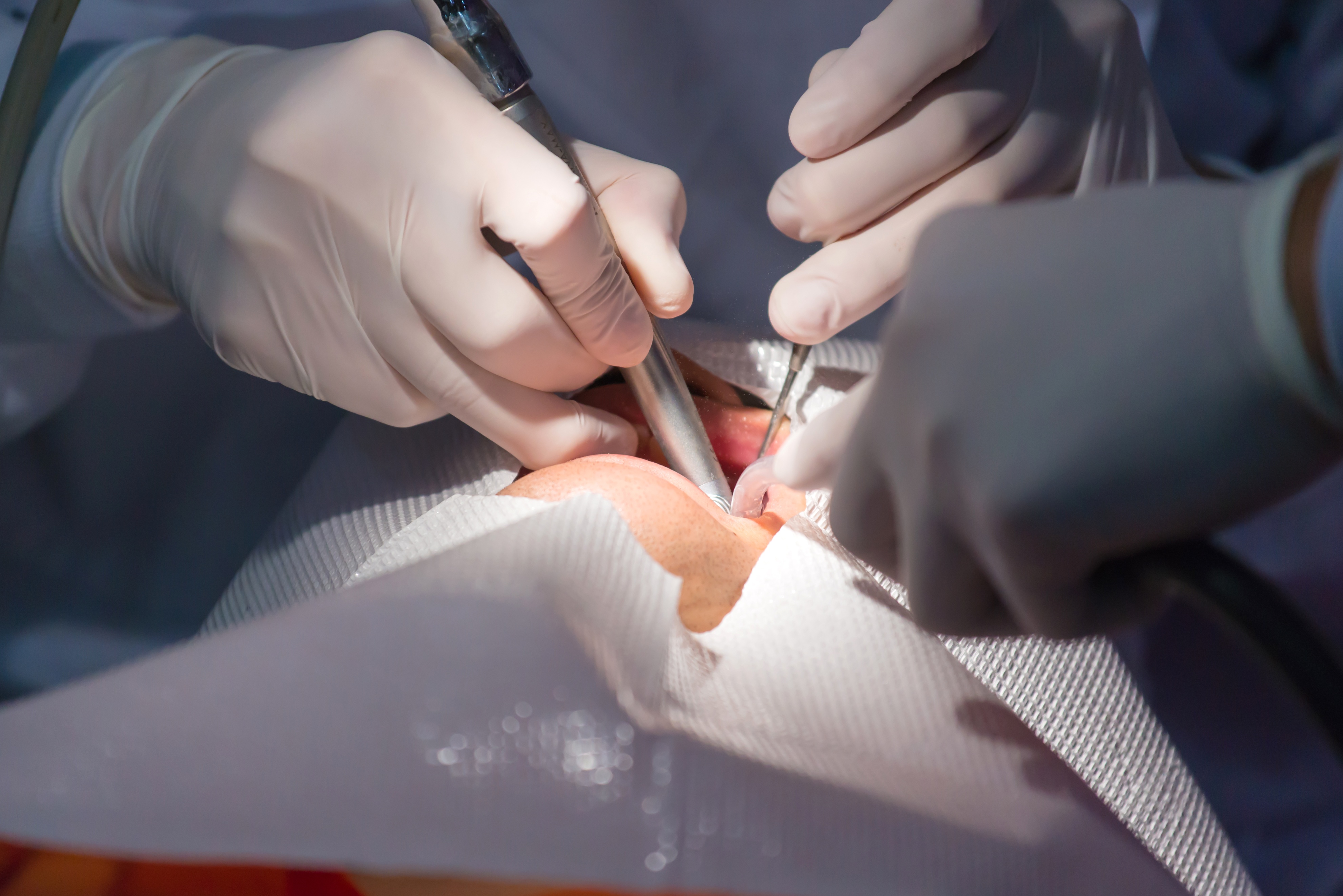 洗牙的危害多大,洗牙的十大危害坏处