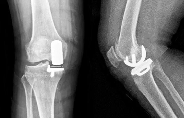 活动与固定平台单髁假体对膝关节前内侧骨关节炎的疗效比较