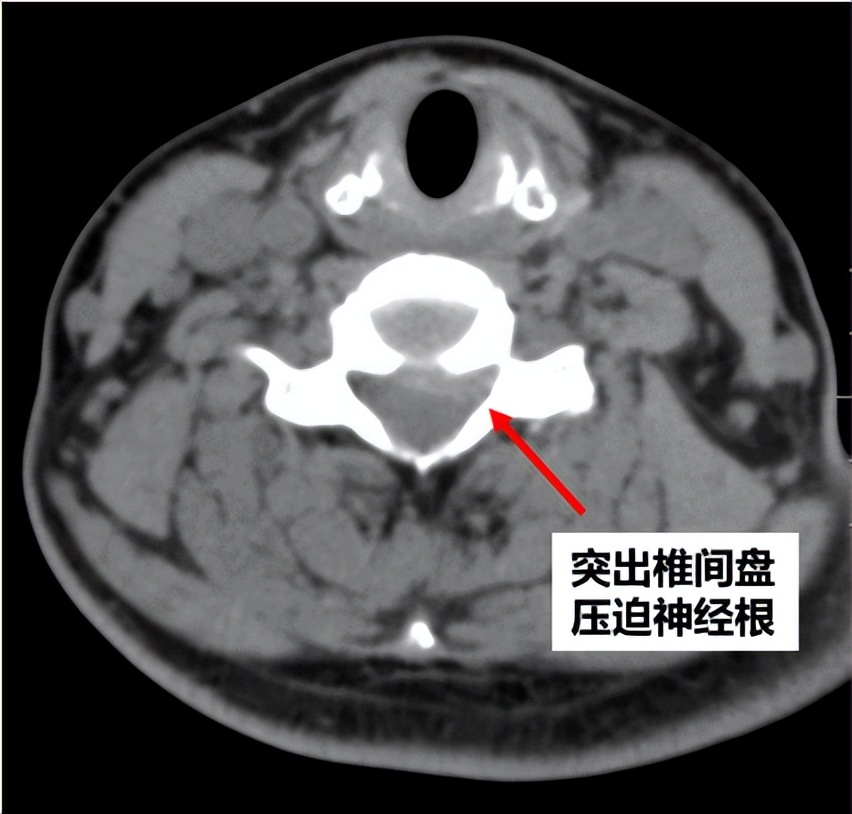 手痛手麻手僵硬是什么原因,手麻引起手指中节疼是什么原因