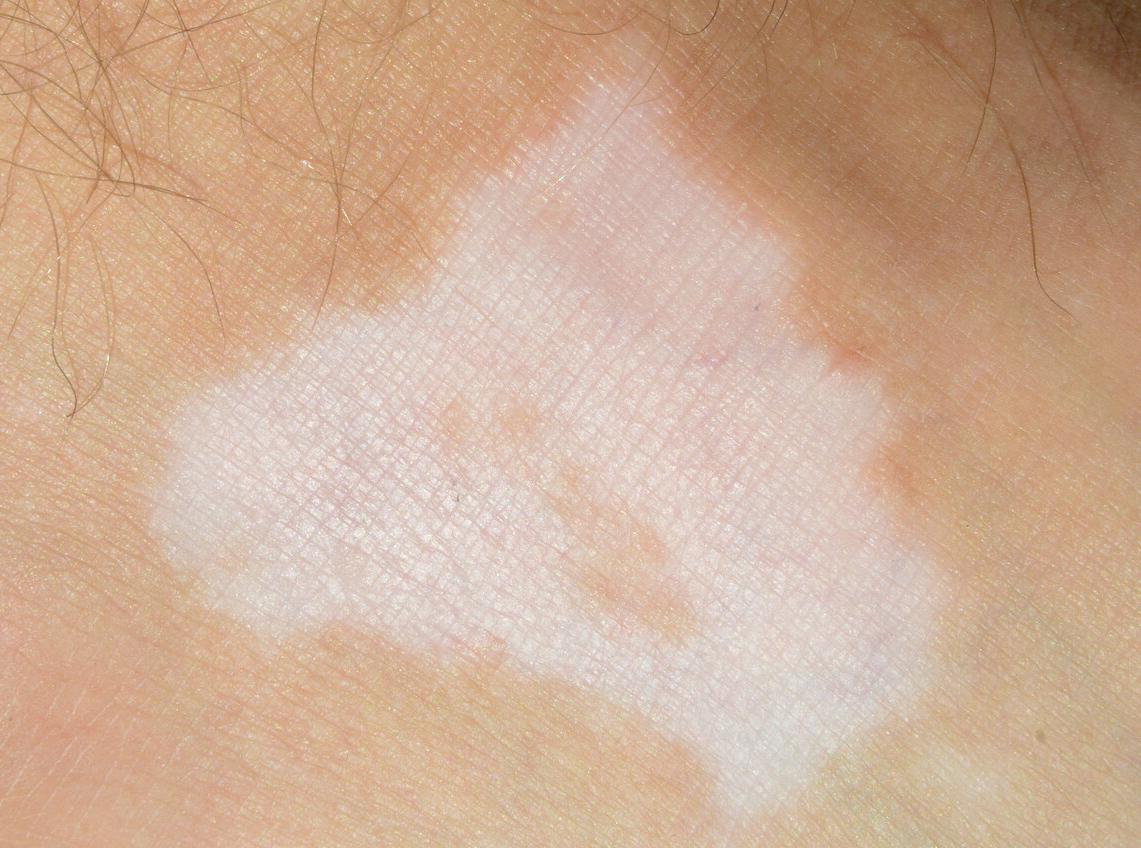 稳定期的白斑怎样快速复色,一般照几次白斑可以复色