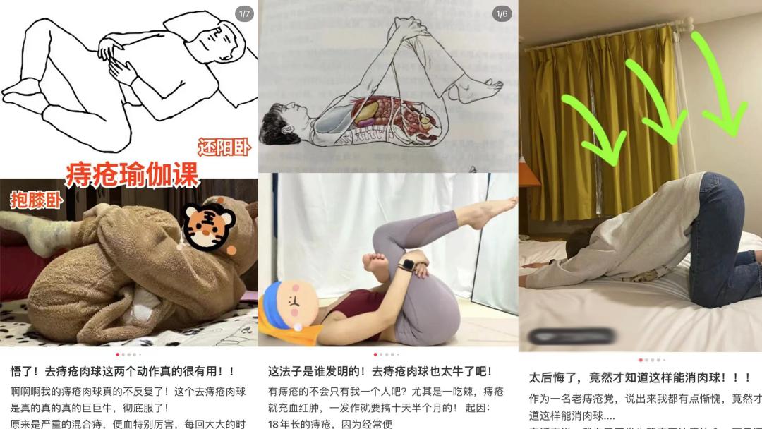 解决痔疮你可以试试这些方法,根除痔疮最好的办法