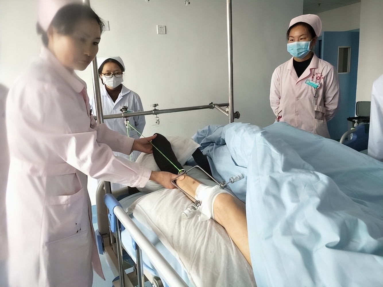 儿童股骨干粉碎性骨折对位不太好,儿童股骨干骨折石膏固定