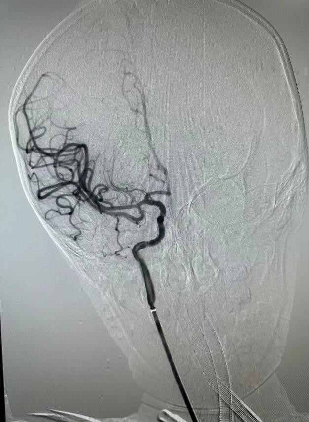 脑卒中多学科协作的好处,多学科联合协作抢救患儿