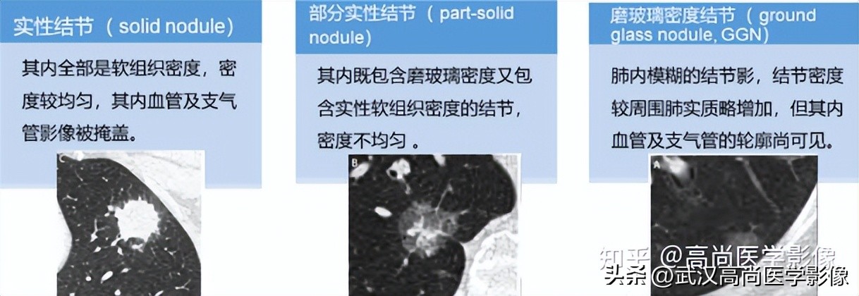10毫米的肺结节恶性死亡率有多大,1厘米多的肺结节良性可能性多大