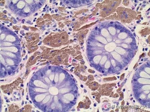 结肠黑变病是什么原因引起的,老人得结肠黑变病饮食怎么调理