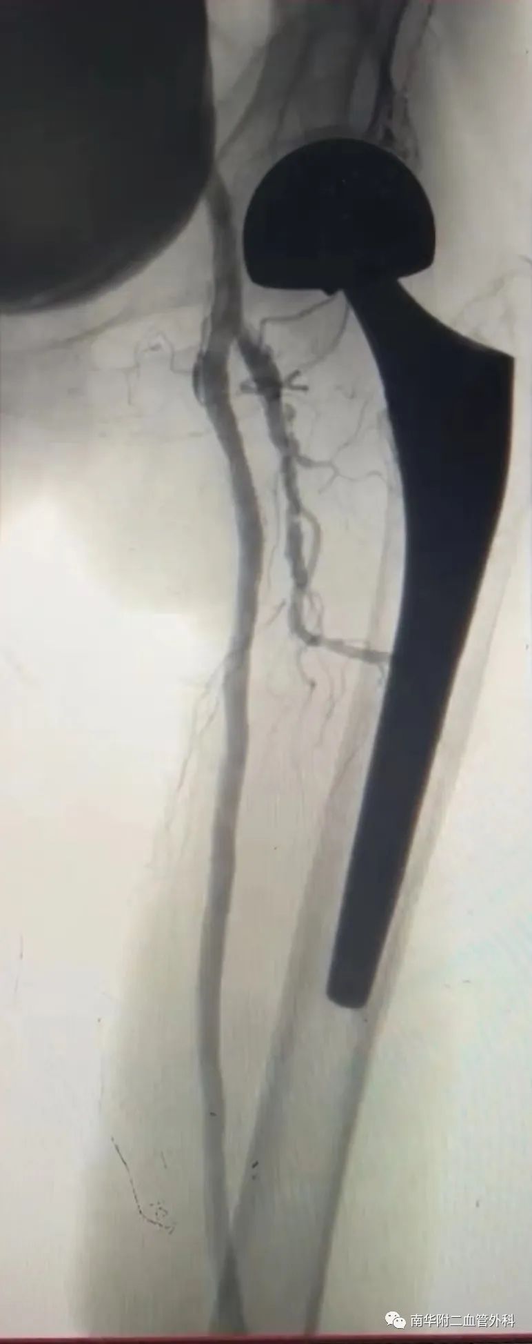 下肢血管闭塞介入治疗视频,动脉血管狭窄的最新介入治疗方法