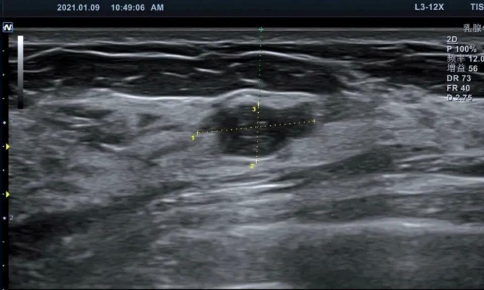 乳腺结节微创旋切术的全过程,乳腺结节多大可以微创手术了