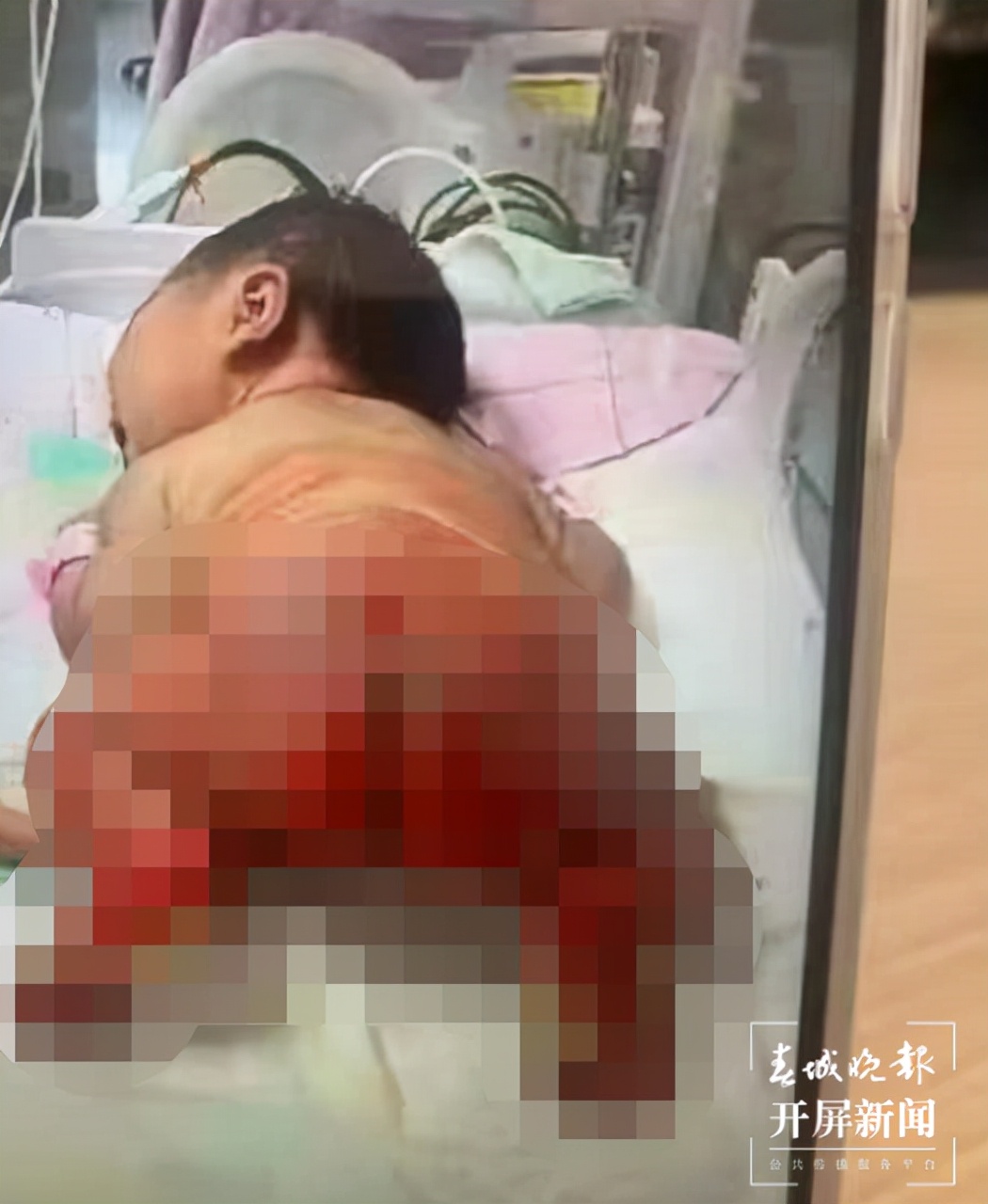 一女婴疑似在产科被烫伤,广东惠来母婴烫伤